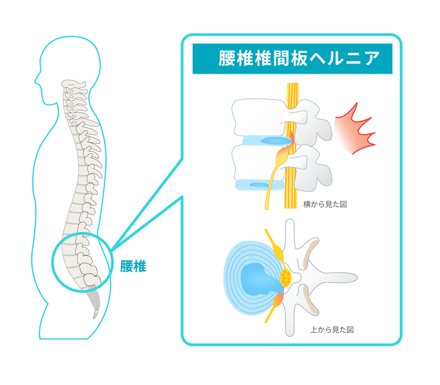 腰椎椎間板ヘルニア